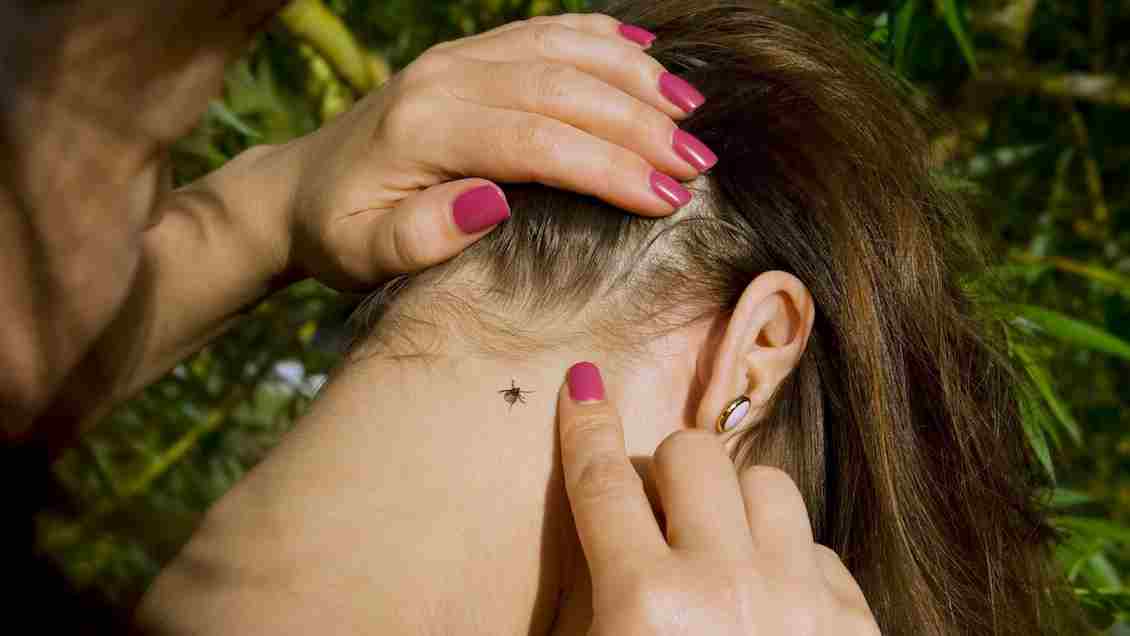a wood tick embedded in human skin on scalp near hairline